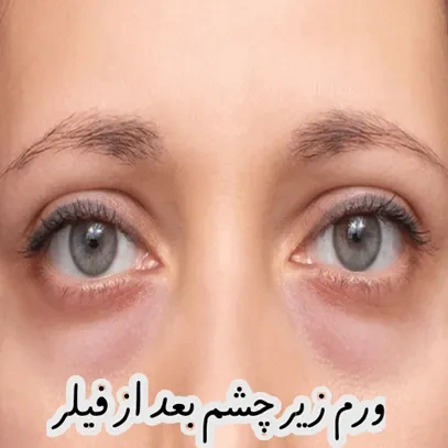 علت ورم زیر چشم بعد از تزریق فیلر و مراقبت‌های ضروری برای پیشگیری